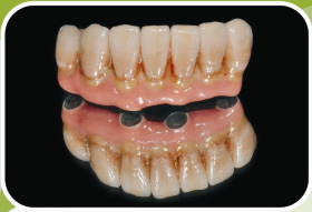 dental implant overdenture