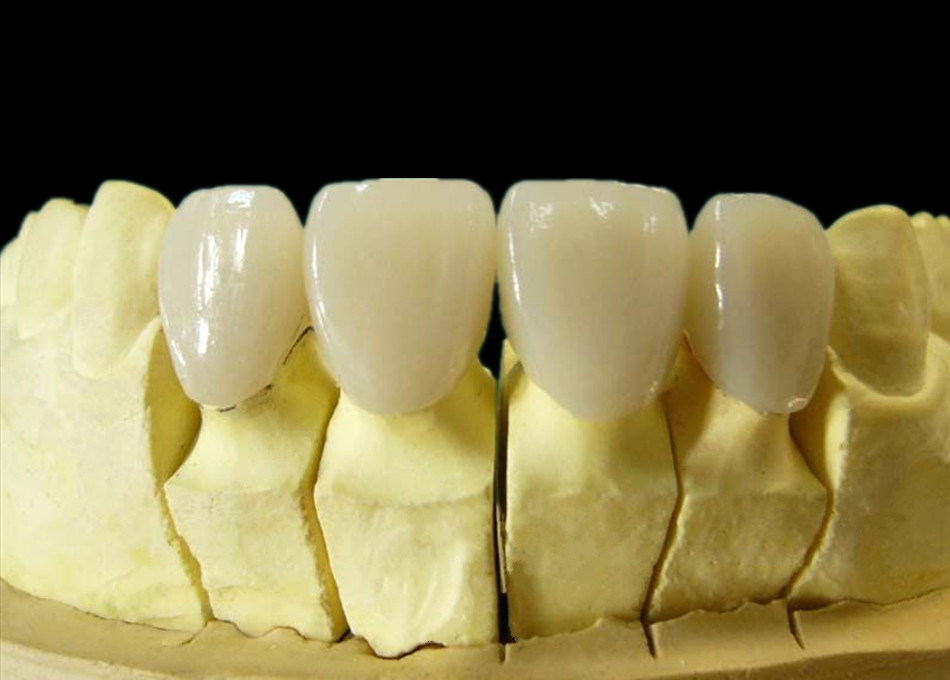 Dental PFM-Porcelain fused to Colbat-Chrome alloy crown 