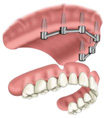 Removable Prosthetic Implant Overdentures