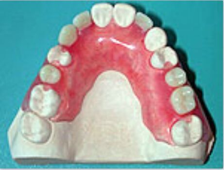 Removable Prosthetic Valplast Denture