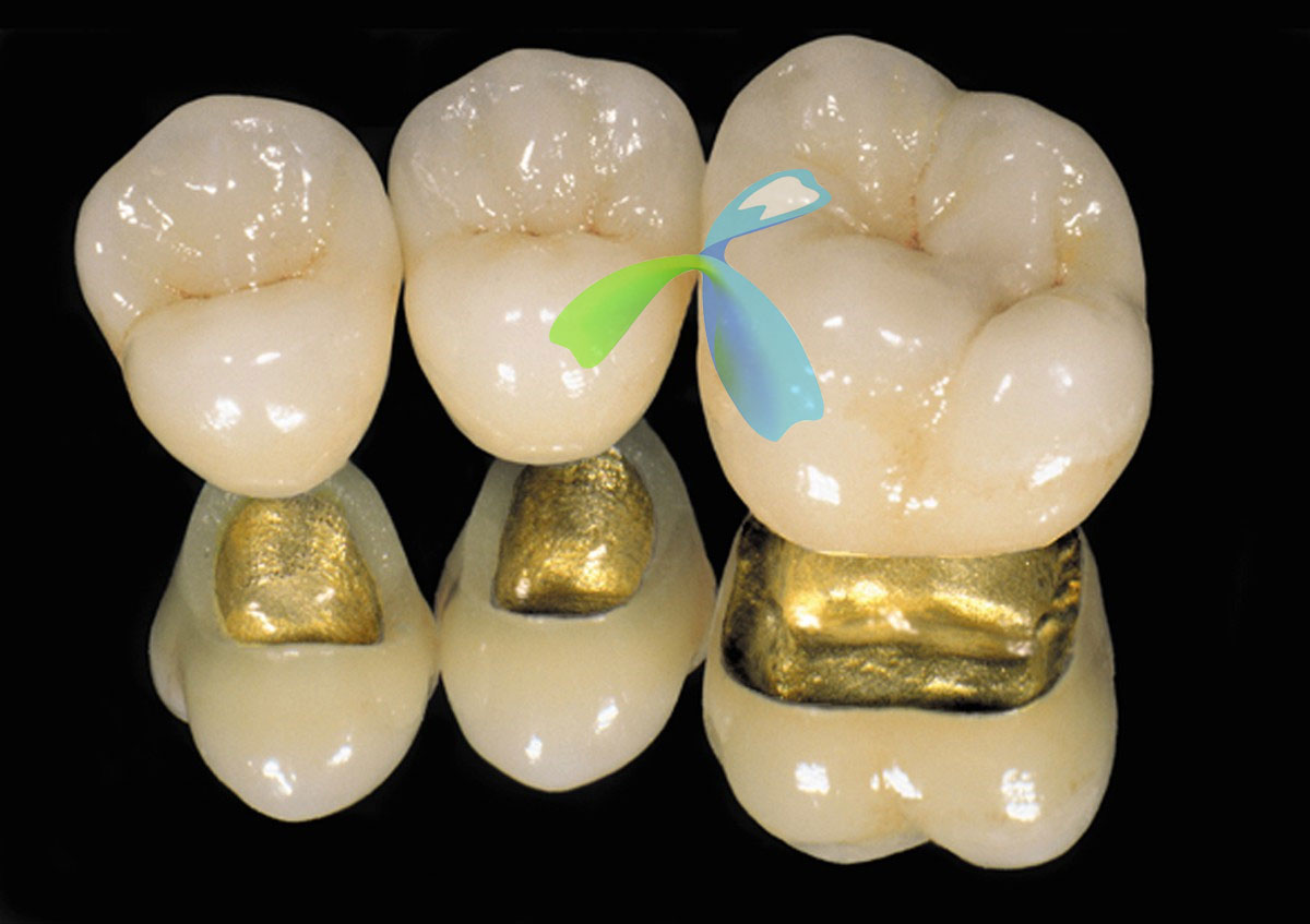 Non-Precious/Semi-Precious/Precious Porcelain Crown,  Captek Chinese outsourcing dental lab