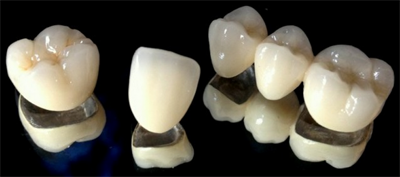 Metal Removable denture Custom removable denture Stainless steel pure titanium removable denture holder Removable denture