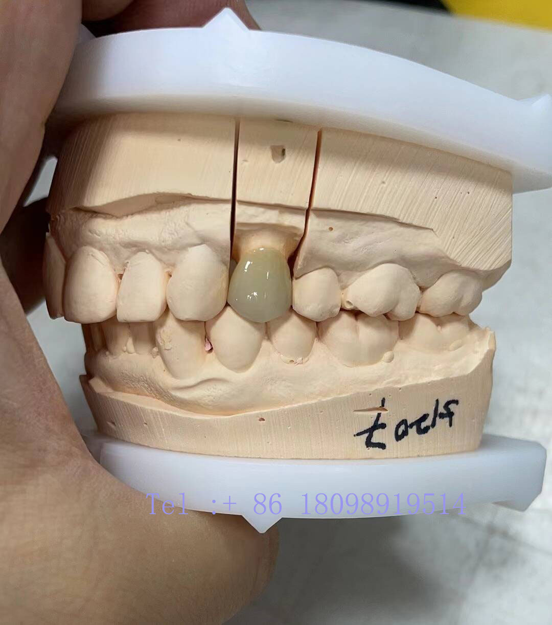 Metal Removable denture Custom removable denture Stainless steel pure titanium removable denture holder Removable denture