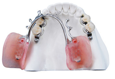 Metal crown/bridge China Outsourcing Dental