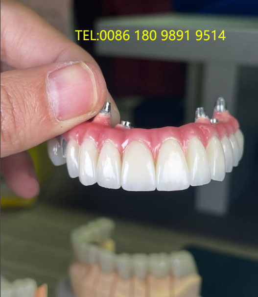 Cement-Retained Implant