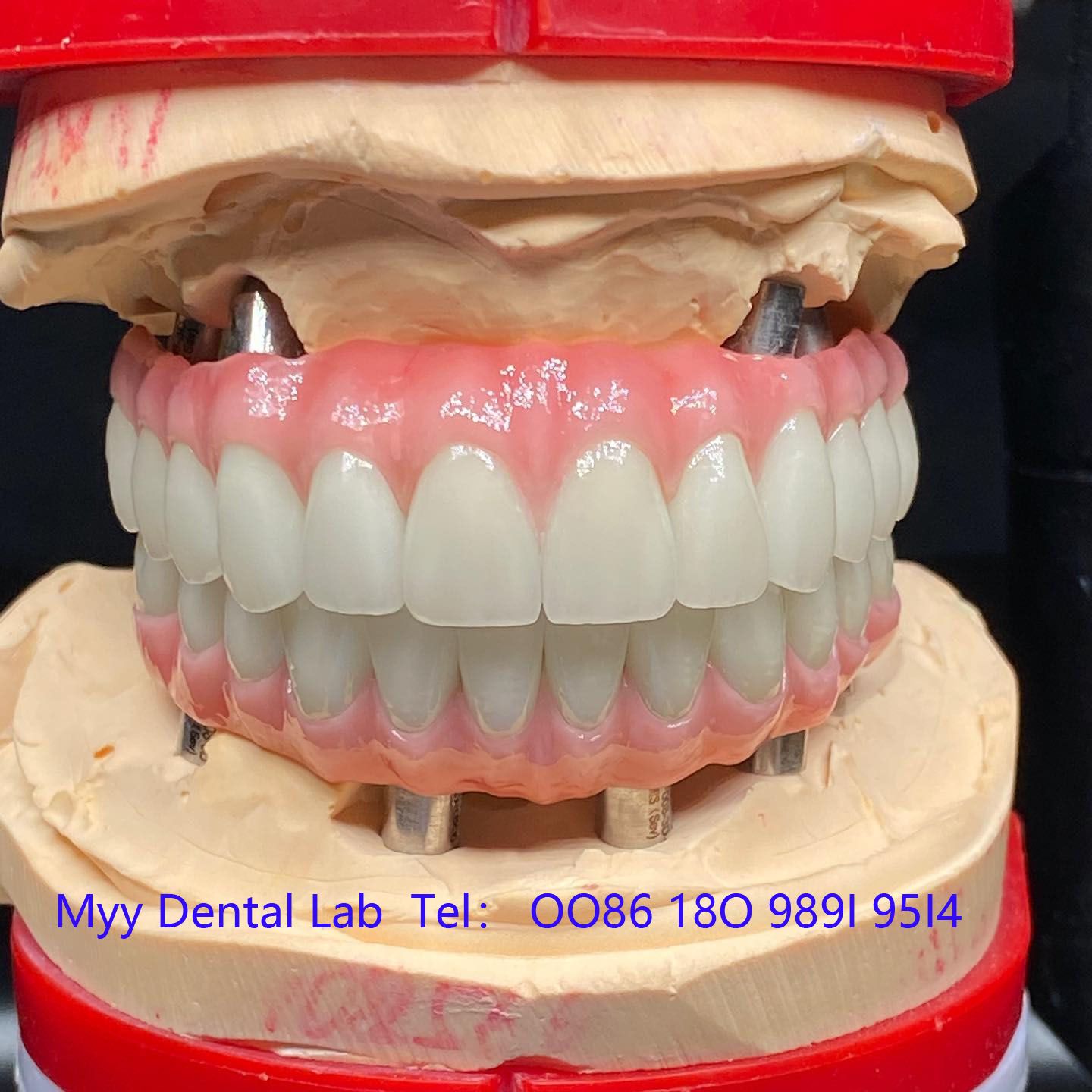 Implant Screwed Bridge - China Dental Lab Implant Crown 