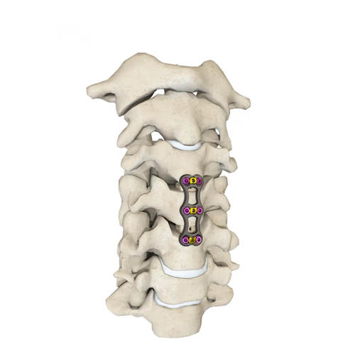 Anterior Cervical Plate - Type II